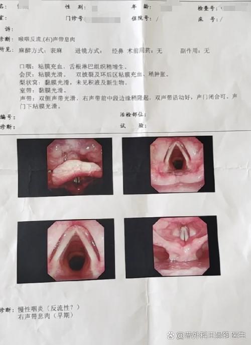 声带受损声音嘶哑怎么办