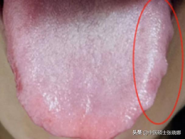 半夏泻心汤舌苔图片图标