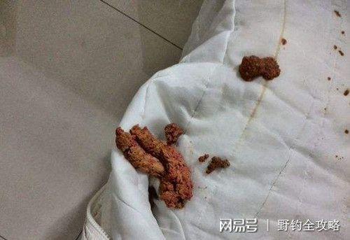 骇爪屁股流出酸奶是癌症吗