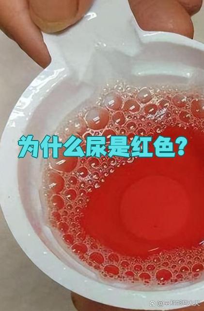 为什么打完点滴尿是红色