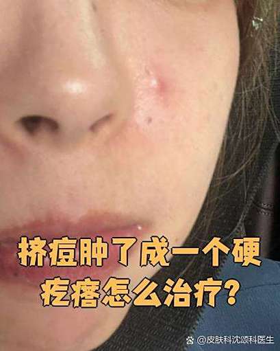 痘痘挤完后红肿有硬块怎么办