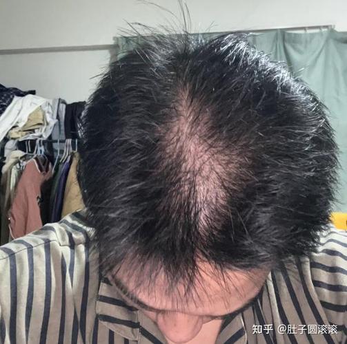 40岁开始秃顶正常吗