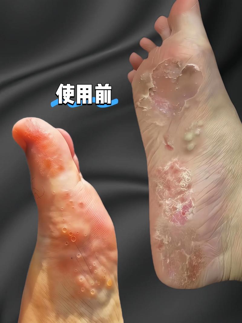 真菌感染vs幽匿mc