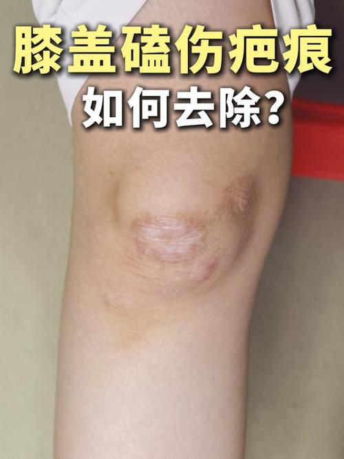 腿上摔跤留了疤痕怎么去除