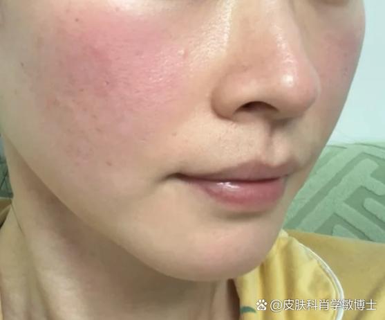 脸过敏敷香蕉脸刺痛