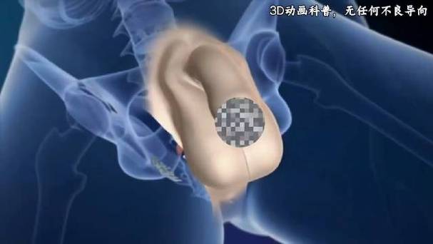 男子睾丸增大手术3D模拟