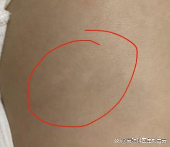 白色糠疹白斑能根除吗