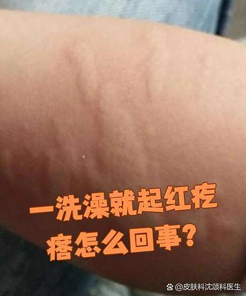 一洗澡就出疹子要警惕