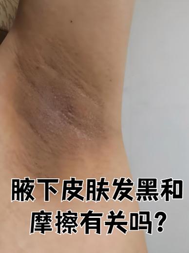 女人腋下黑怎么解决