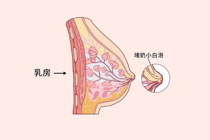 出奶孔堵截图3