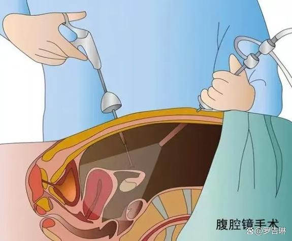 tips手术到底该不该做