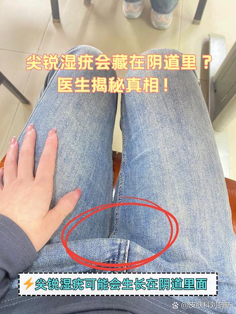 尖锐湿症病毒怎么彻底清除