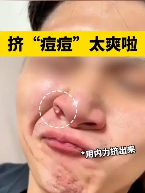 脓包痘痘如何处理