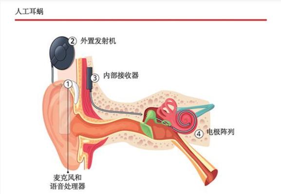 戴了耳蜗6年了还是听不懂