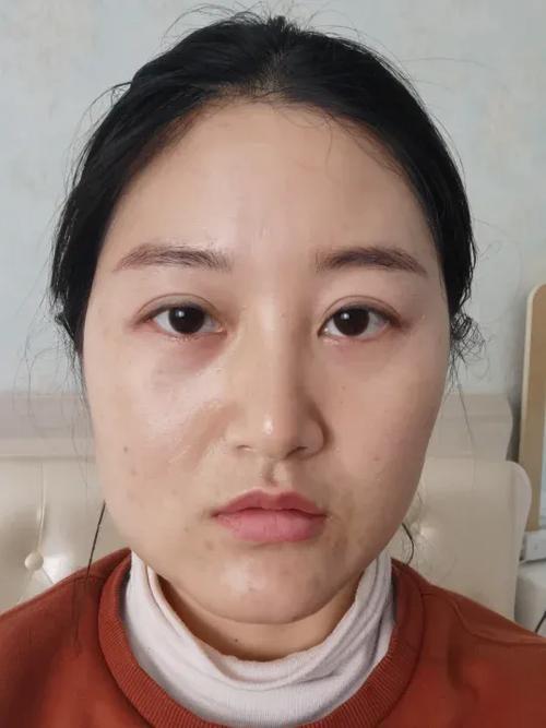 左右脸不对称