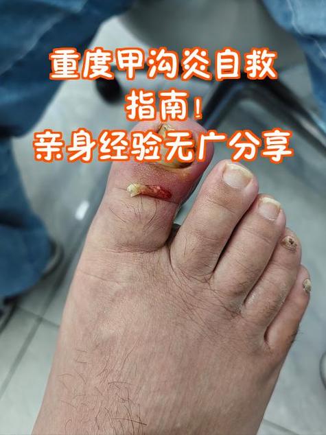 修脚甲沟炎一次大概多少钱