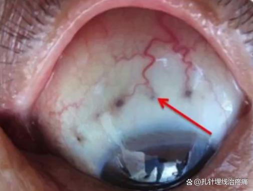 眼睛看出去有个黑圈在飘