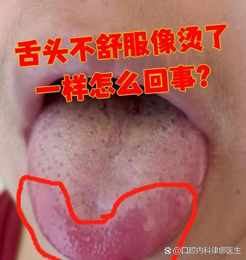 舌头像开水烫了的感觉是什么原因