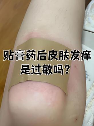 膏药贴后留下的胶印怎么去