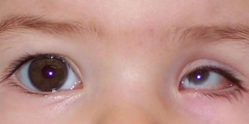 先天性左眼小眼球能整形吗