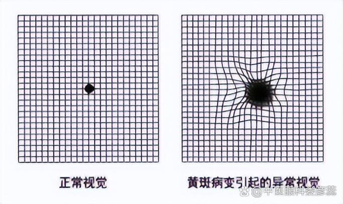 一只眼看东西变小变形变暗