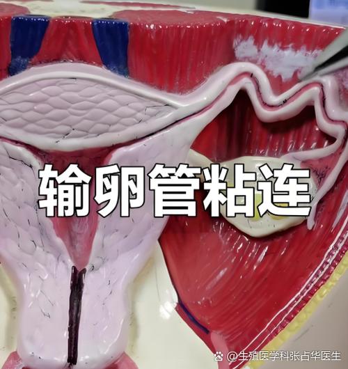 输卵管粘连能自然怀孕吗