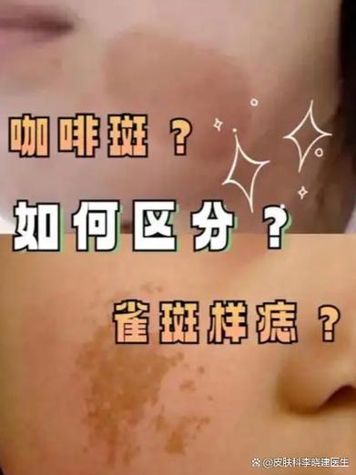 去雀斑的小妙招