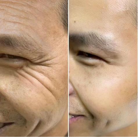 男人脸部皮肤松弛怎么办