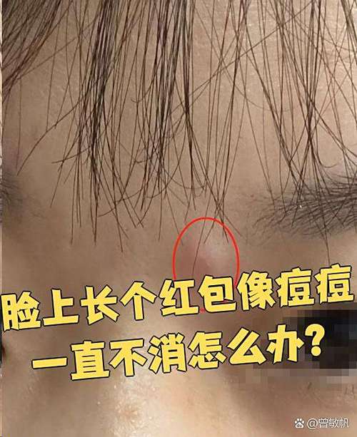 脸上红包一直不消