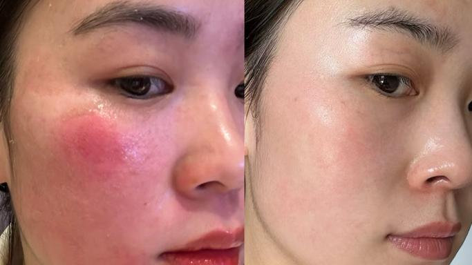 脸上皮肤红血丝怎么修复