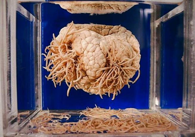 大脑里长寄生虫严重吗