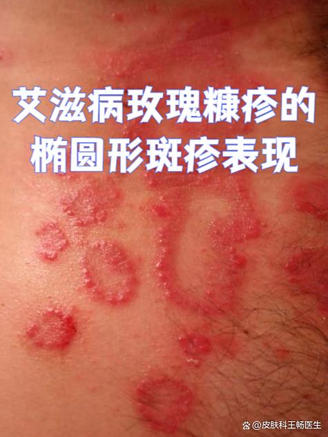 皮肤出现红色圈状红斑