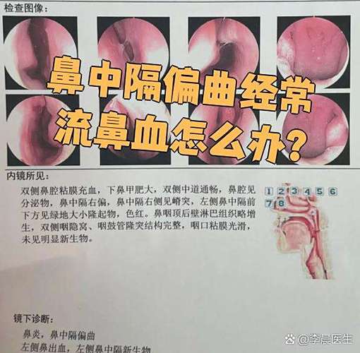 流鼻血咋办
