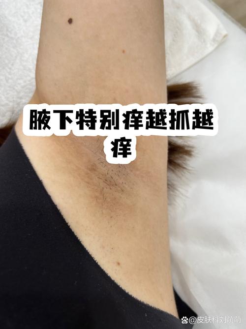 腋下痒痒越抓越痒