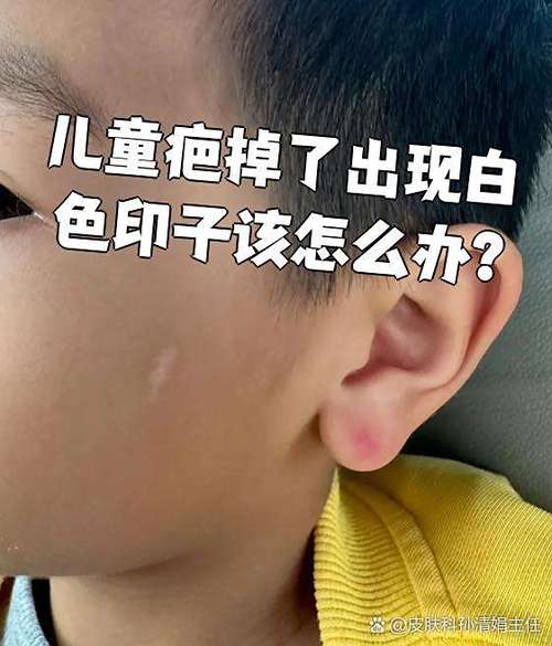 儿童疤掉了白色印子