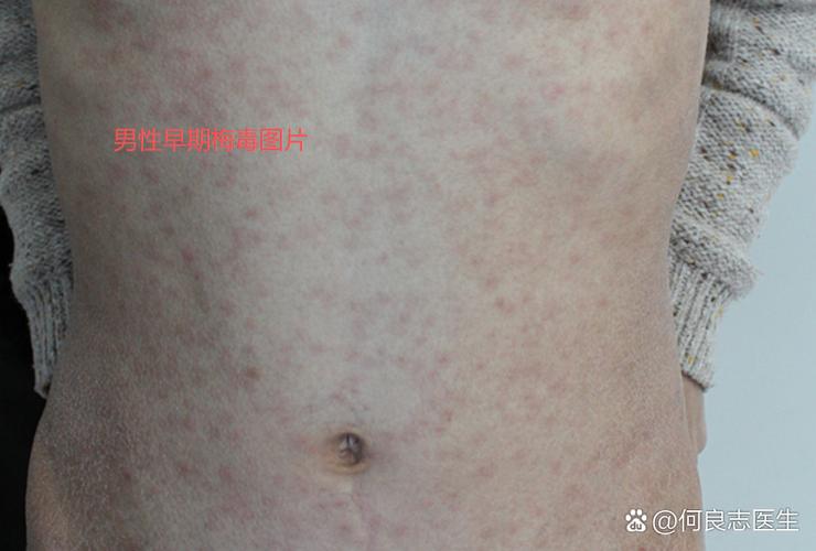 男性早期梅毒图片