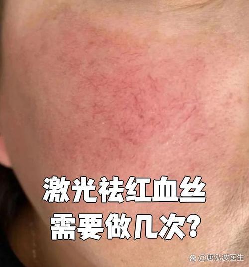 激光祛红血丝大概要多少钱