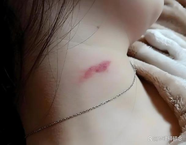 怎样才能留下吻痕
