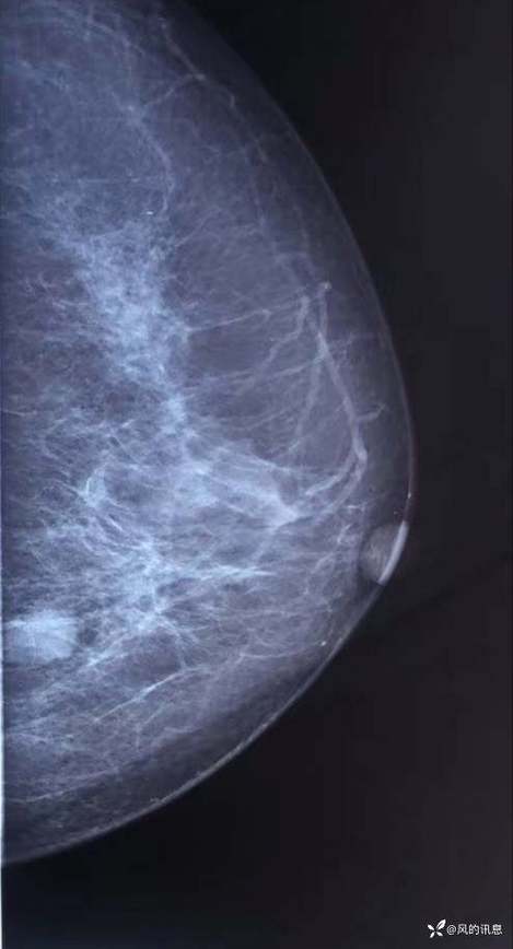 乳房中间有个大圆核