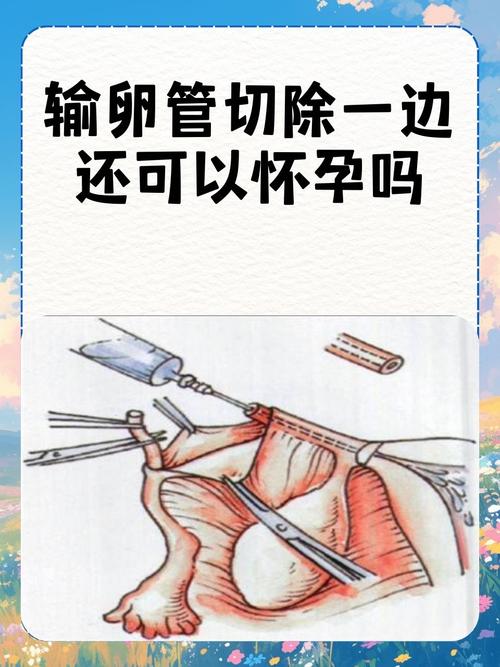 输卵管切除十大忠告