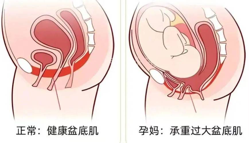盆基底松弛的6大表现