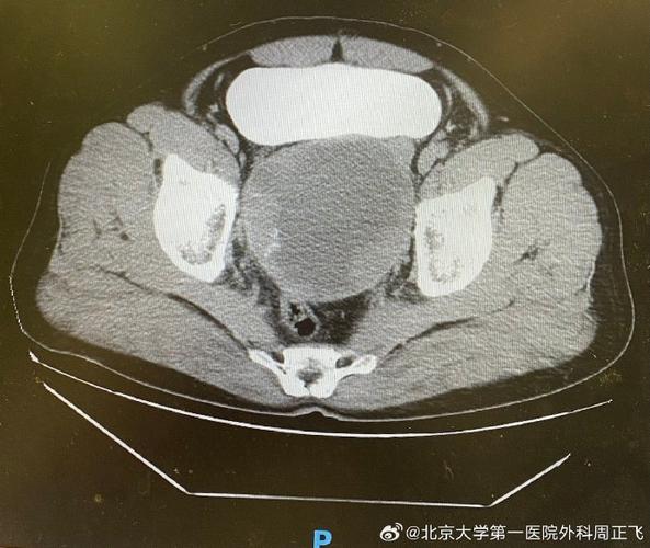 不除外转移可能性多大