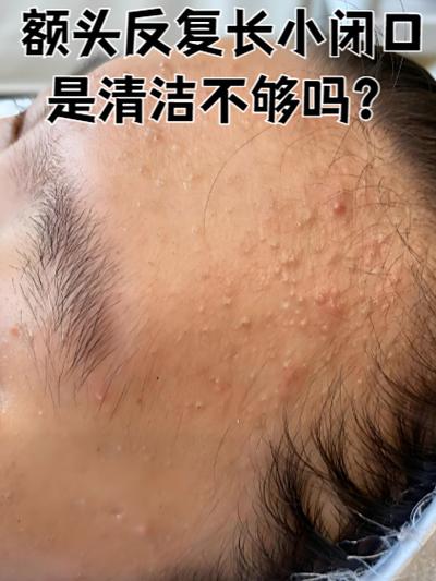 额头上长了很多小米米怎么办截图2