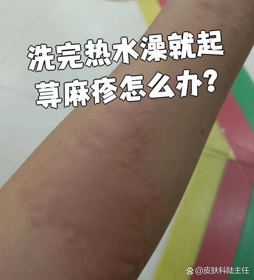 荨麻疹可以洗澡吗