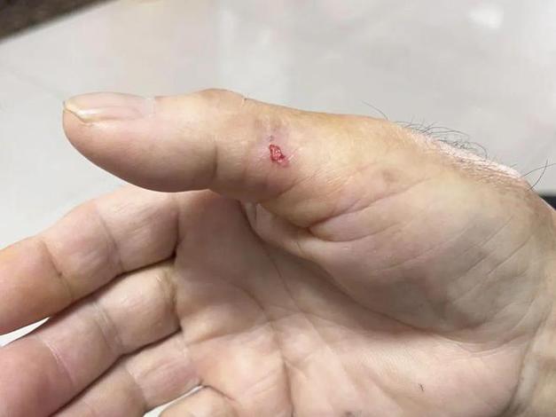 被小仓鼠咬破了一点点血该怎么办