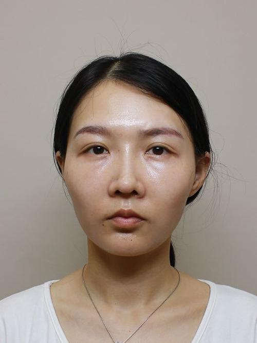 30岁面部凹陷还能恢复吗
