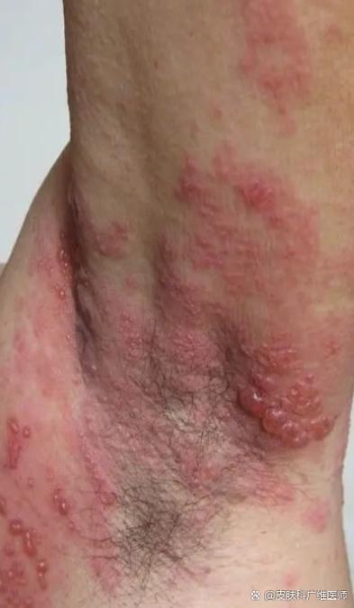 腋下痒挠烂了怎么办
