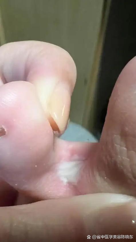 脚趾缝痒