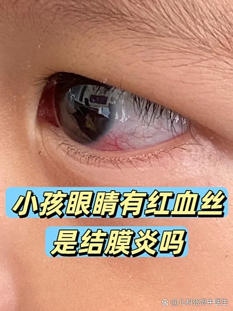 流鼻血眼睛红什么原因