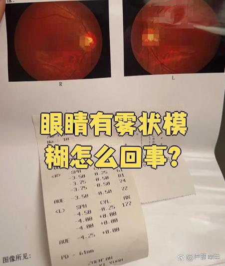 眼睛上有一层雾